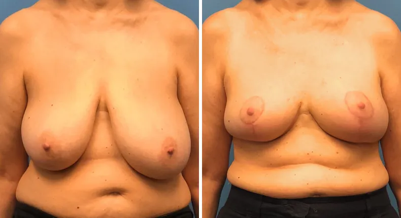 Before and after breast reduction: woman's breasts from the front