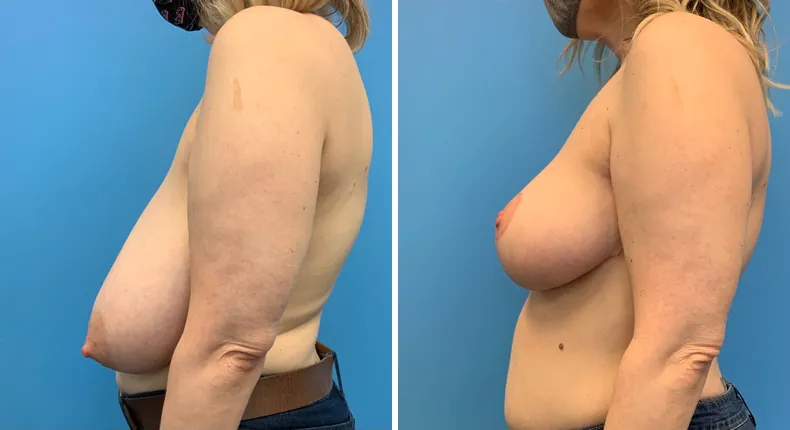 Before and after breast reduction: patient's breasts from the left side