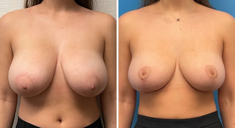 Before and after breast reduction: woman's breasts from the front