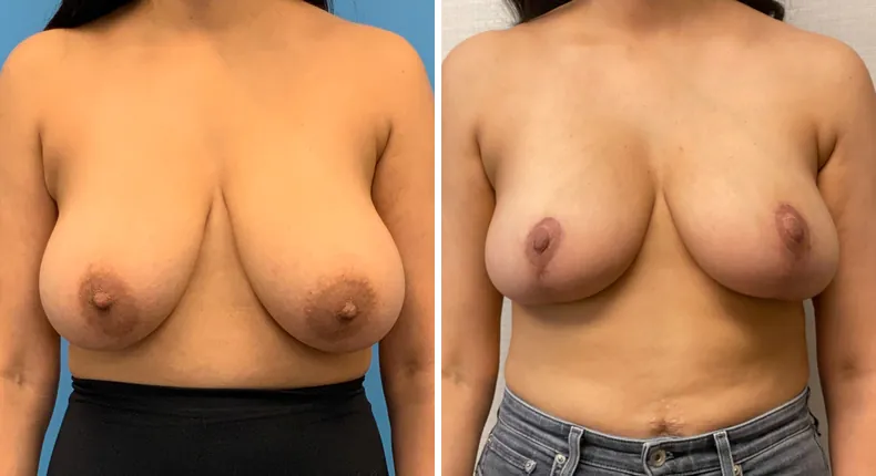 Before and after breast reduction: woman's breasts from the front