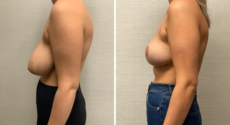 Before and after breast reduction: patient's breasts in left profile