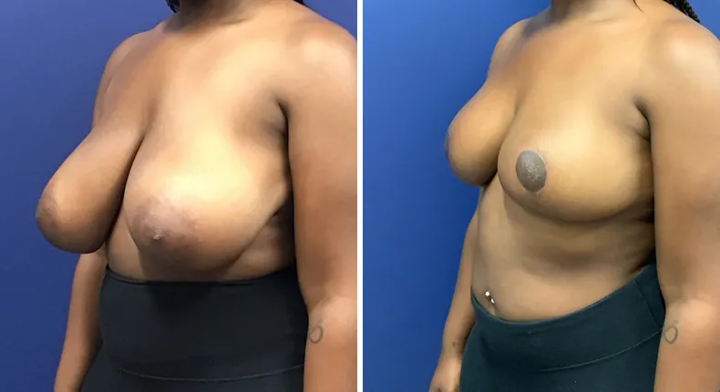 Before and after breast reduction: patient's breasts at a left angle