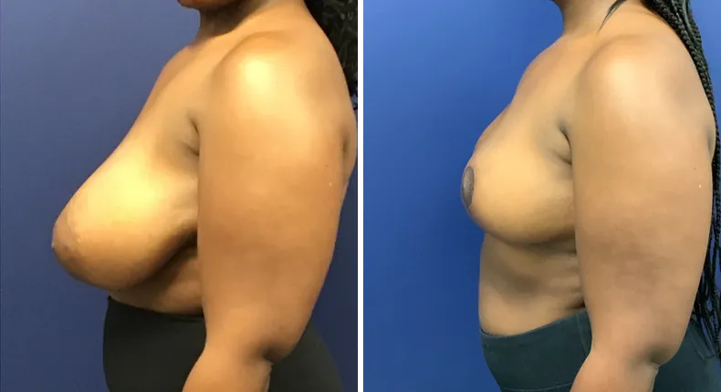 Before and after breast reduction: patient's breasts from the left side