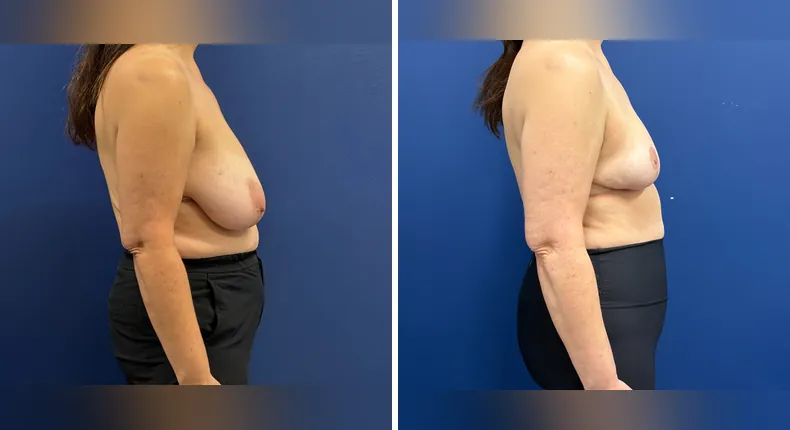 Before and after breast reduction: woman's breasts