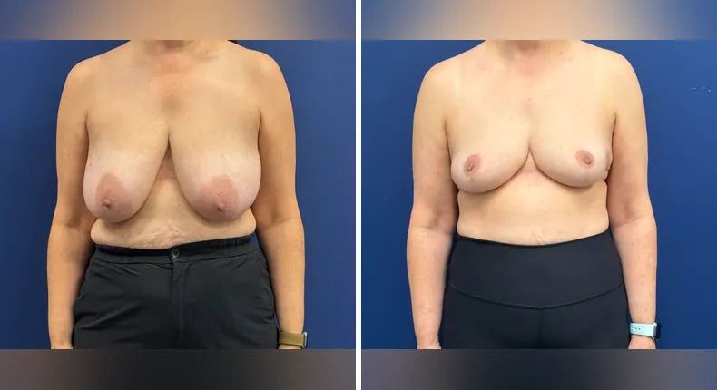 Before and after breast reduction: woman's breasts