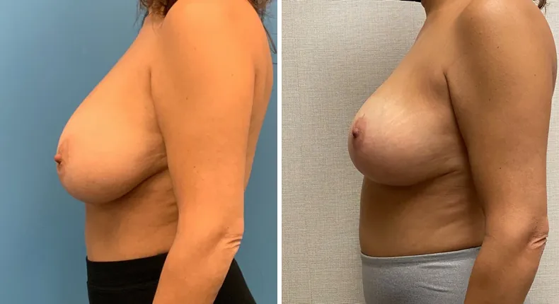 Before and after breast reduction: patient's breasts from the left side