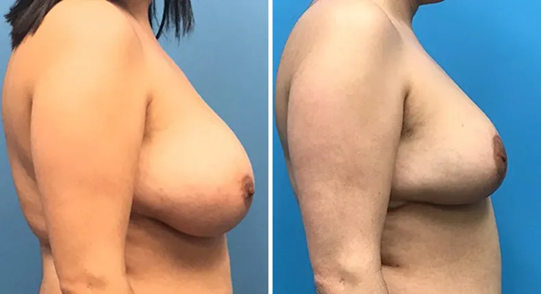 Before and after breast reduction: patient's breasts from the right side