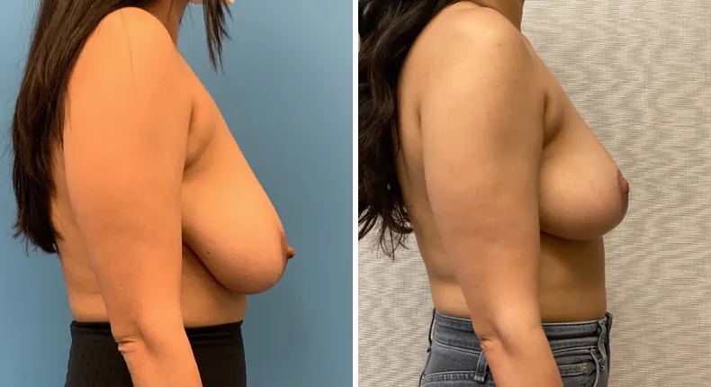 Before and after breast reduction: woman's breasts from the right side