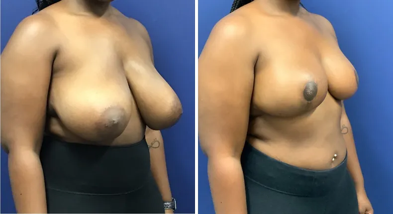 Before and after breast reduction: patient's breasts at a right angle