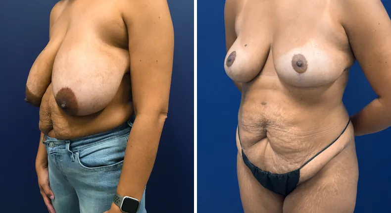 Before and after breast reduction: patient's breasts from the left side