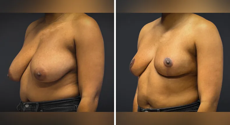 Before and after breast reduction: patient's breasts