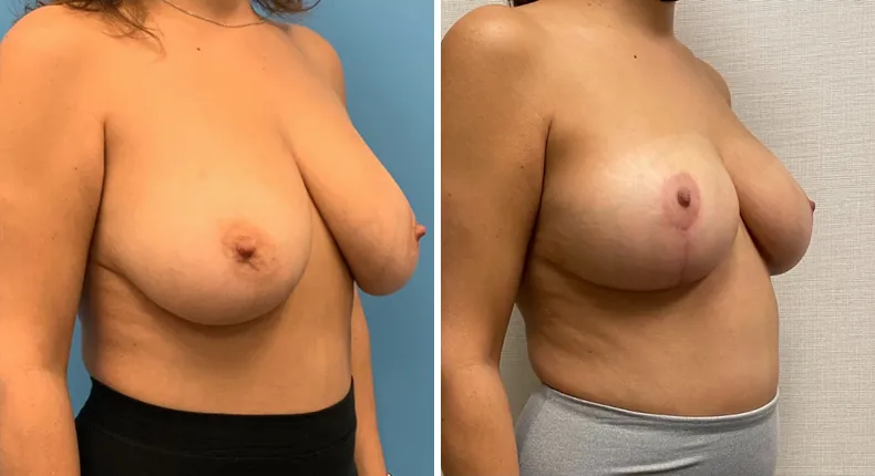 Before and after breast reduction: patient's breasts at a right angle
