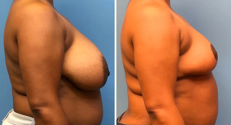 Before and after breast reduction: patient's breasts from the right side