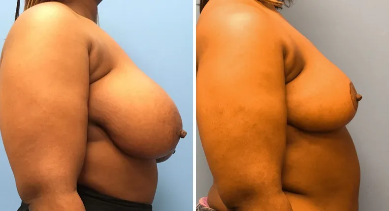 Before and after breast reduction: woman's breasts from the right side