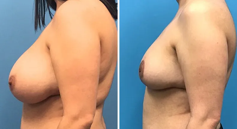 Before and after breast reduction: patient's breasts from the left side