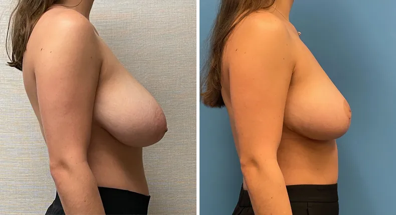 Before and after breast reduction: woman's breasts from the right side