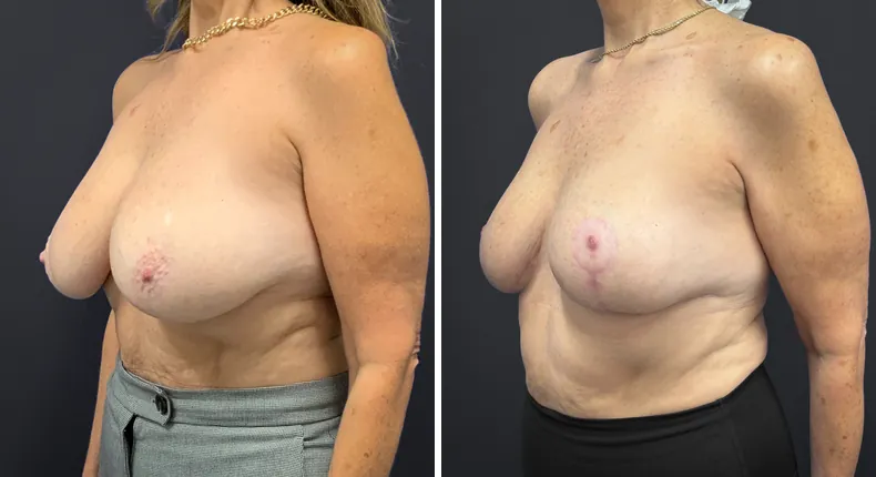 Before and after breast reduction: patient's breasts at a left angle