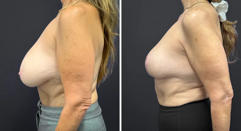 Before and after breast reduction: patient's breasts from the left side