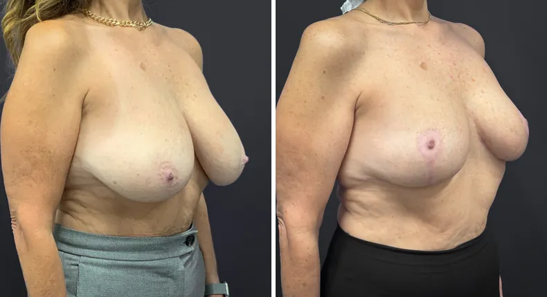 Before and after breast reduction: patient's breasts at a right angle