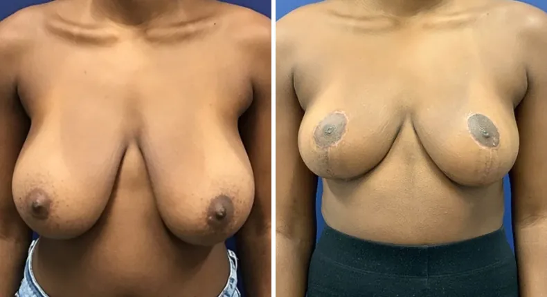 Before and after breast reduction: patient's breasts from the front