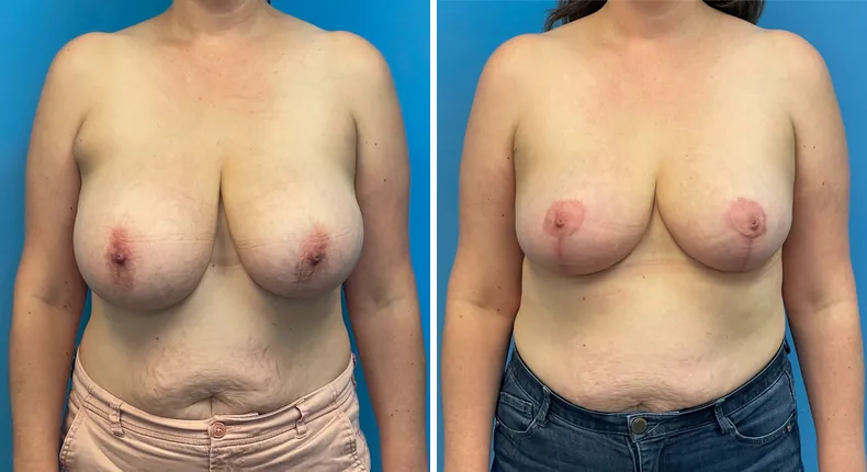 Before and after breast reduction: patient's breasts from the front