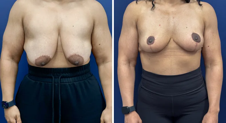 Before and after breast reduction: patient's breasts