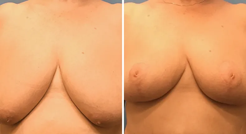 Before and after breast reduction: woman's breasts from the front
