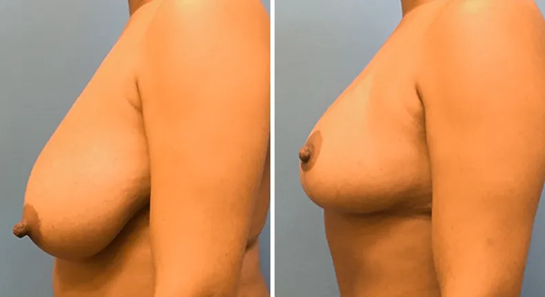 Before and after breast reduction: patient's breasts from the left side