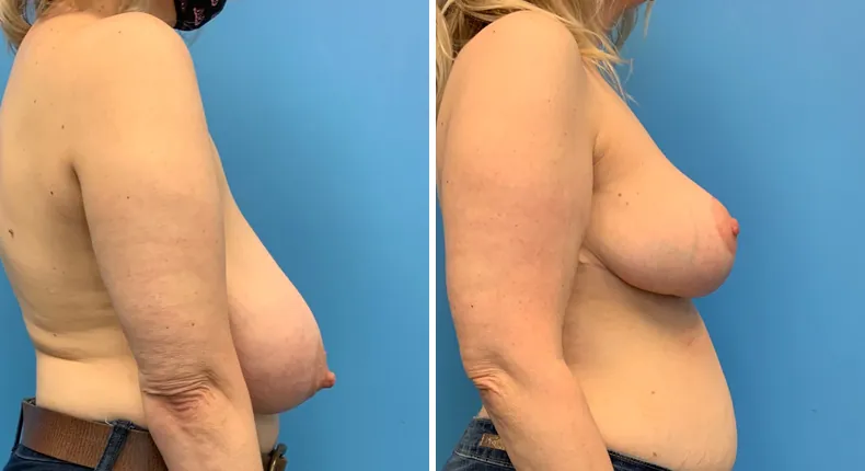 Before and after breast reduction: patient's breasts from the right side