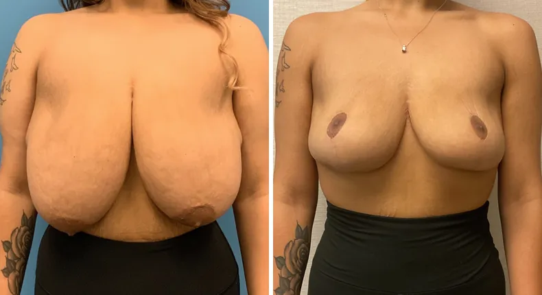 Before and after breast reduction: woman's breasts from the front