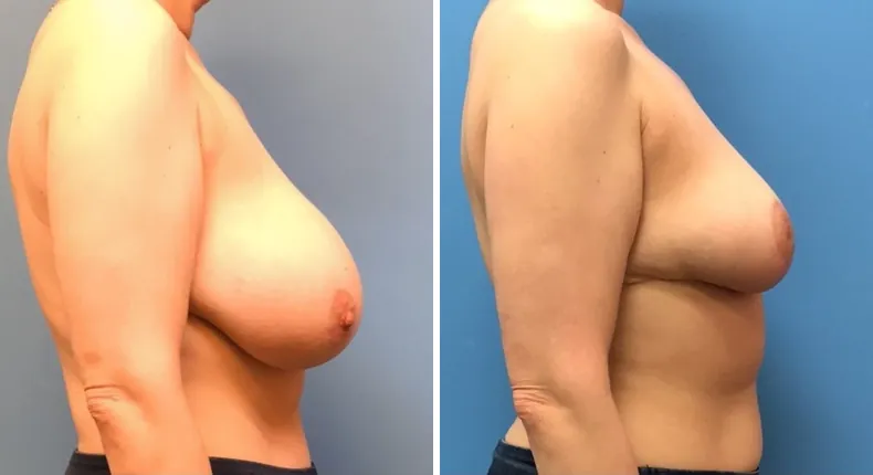 Before and after breast reduction: woman's breasts from the right side