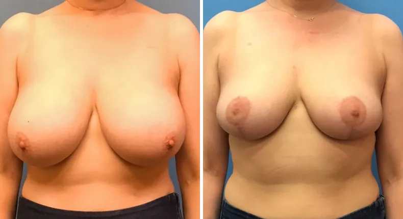 Before and after breast reduction: woman's breasts from the front