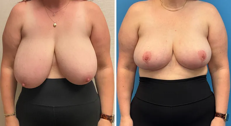 Before and after breast reduction: patient's breasts from the front