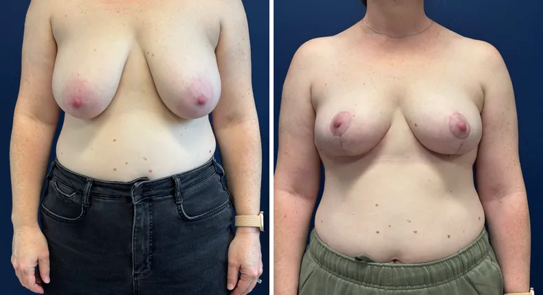 Before and after breast reduction: patient's breasts