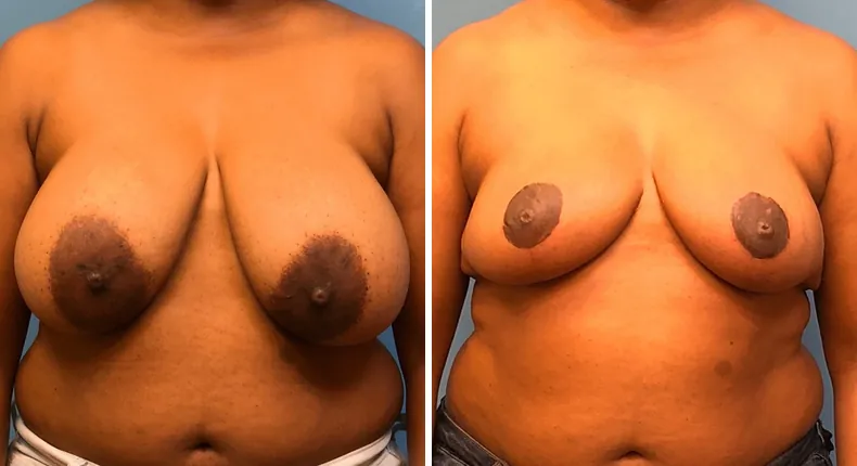 Before and after breast reduction: patient's breasts from the front
