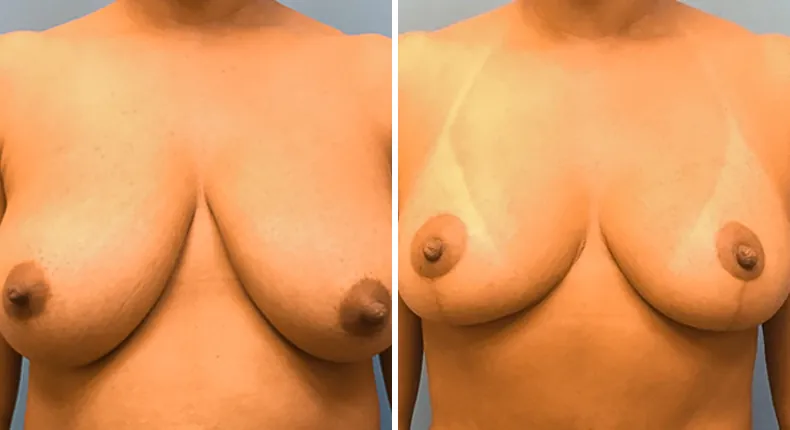 Before and after breast reduction: patient's breasts from the front