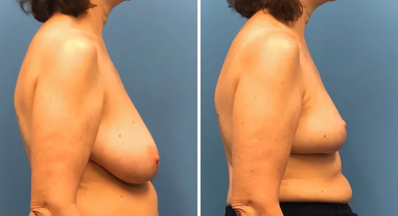 Before and after breast reduction: woman's breasts from the right side