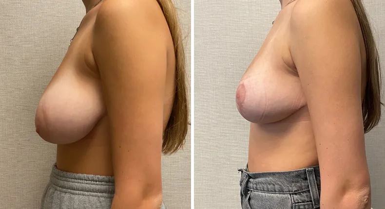Before and after breast reduction: woman's breasts from the left side