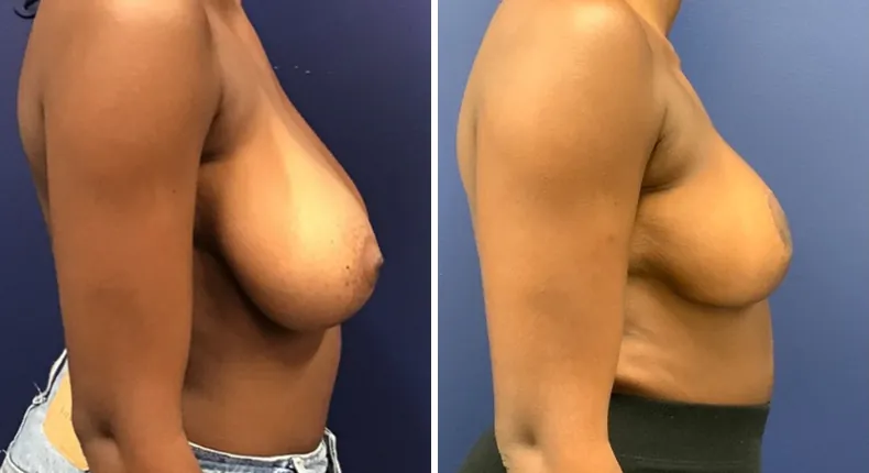 Before and after breast reduction: patient's breasts from the right side