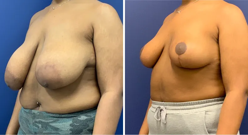 Before and after breast reduction: patient's breasts at a left angle