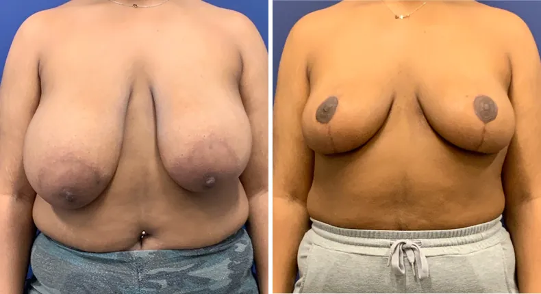 Before and after breast reduction: patient's breasts from the front