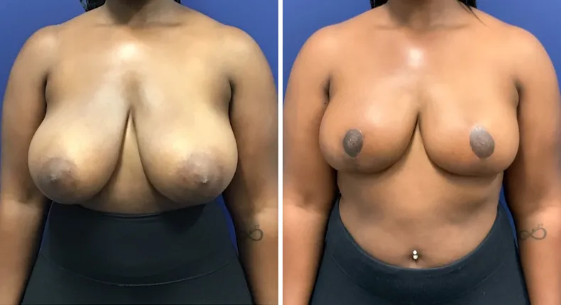 Before and after breast reduction: patient's breasts from the front