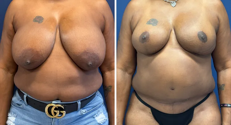 Before and after breast reduction: patient's breasts