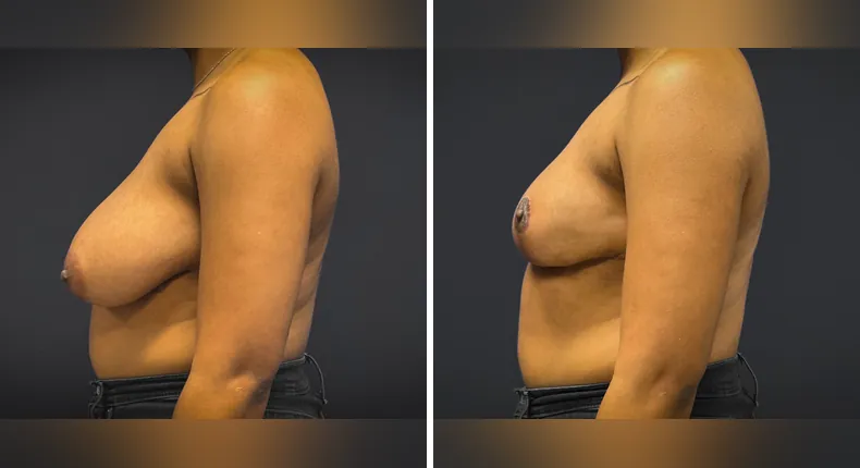 Before and after breast reduction: patient's breasts