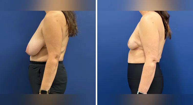 Before and after breast reduction: woman's breasts