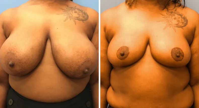 Before and after breast reduction: woman's breasts from the front
