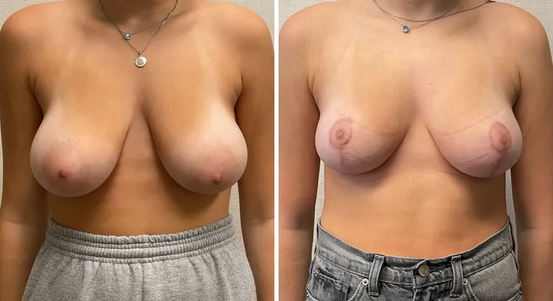 Before and after breast reduction: woman's breasts from the front