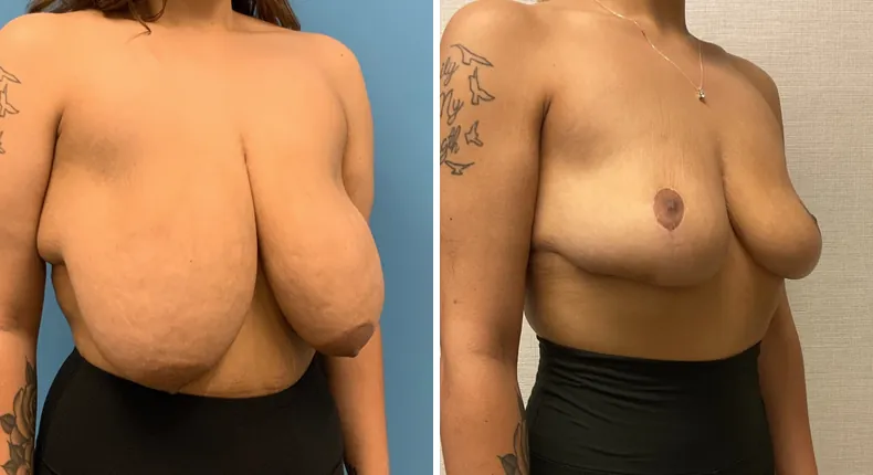 Before and after breast reduction: woman's breasts at a right angle