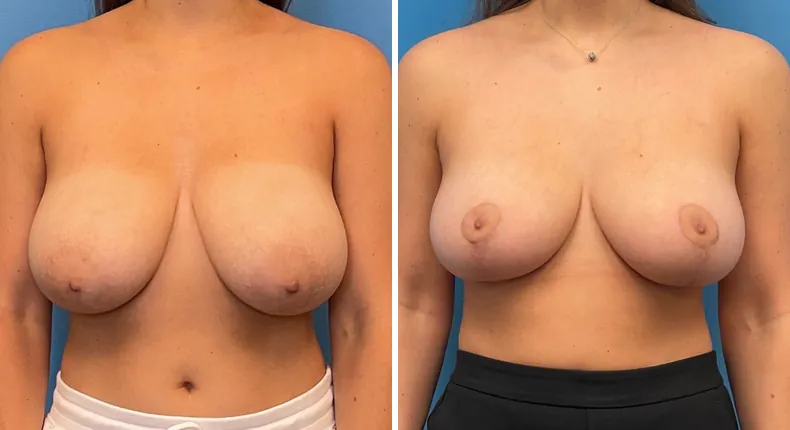 Before and after breast reduction: patient's breasts from the front