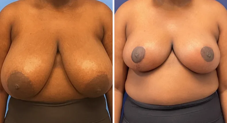Before and after breast reduction: patient's breasts from the front